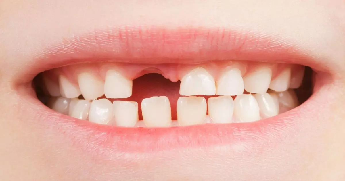 Baby Teeth to Permanent Teeth: An Important Transition