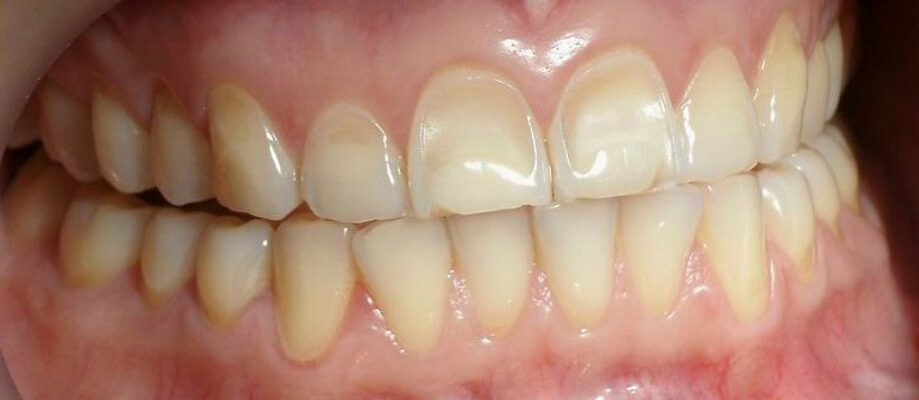 tooth erosion