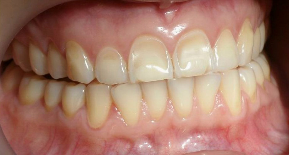 Understanding and Preventing Tooth Erosion