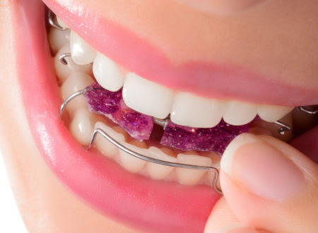 Nailing the Care of Removable Orthodontic Appliances