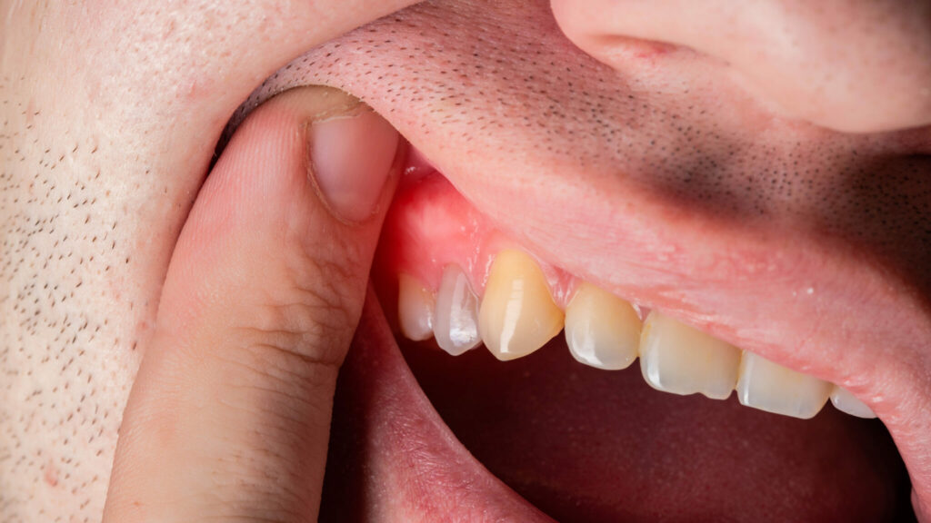 Nutrition Impact on Inflammation and Gums