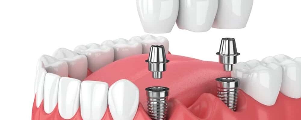 dental implants