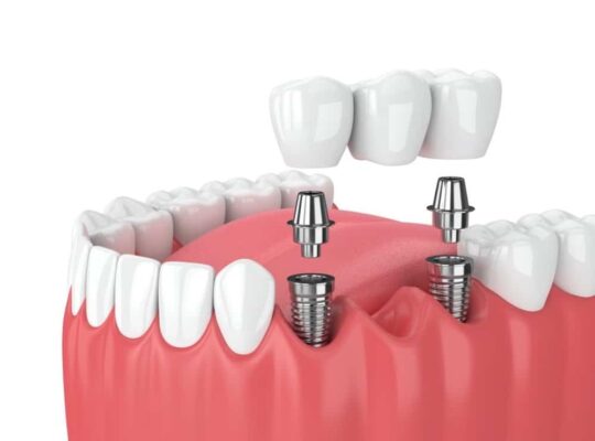 dental implants