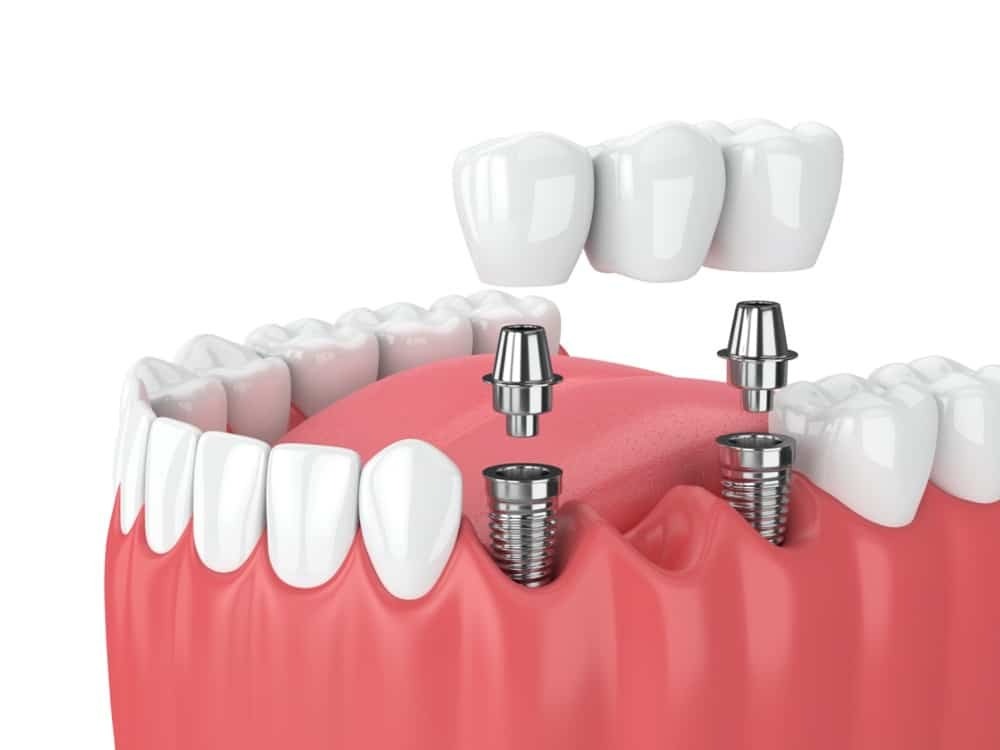 Free Dental Implants: How To Get Yours!